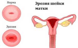 Как происходит прижигание эрозии шейки матки