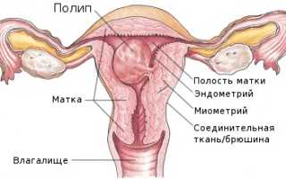 Железистый полип эндометрия