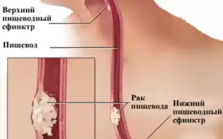 Рак пищевода
