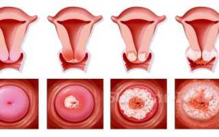 Дискератоз шейки матки