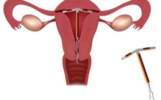 Послеродовая контрацепция