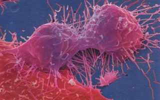 Перерождается ли миома матки в рак матки