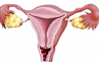 Гиперплазия эндометрия матки в менопаузе и постменопаузе