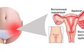 Воспаление яичников: лечение народными средствами