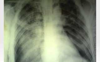 Закрытая форма туберкулеза симптомы первые признаки, лечение