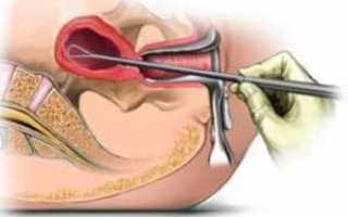 Выскабливание матки