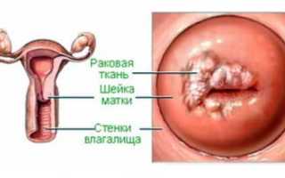 Рак цервикального канала шейки матки