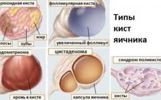 Кольцо Новаринг