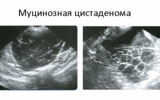 Киста (правого, левого) яичника: лечение, последствия, фото
