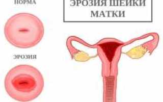 Метод диатермокоагуляции шейки матки