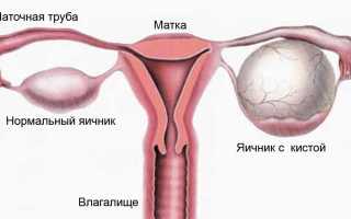 Какие выделения у женщин при кисте яичника