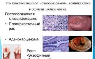 Прогноз при плоскоклеточном раке шейки матки