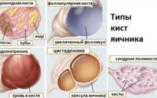 Как пить Дюфастон при кисте яичника