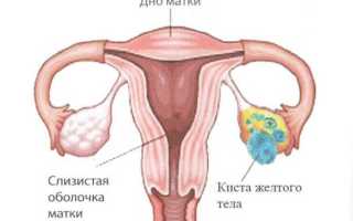 Киста желтого тела правого и левого яичника