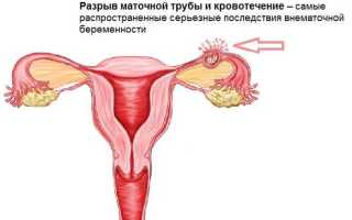 Внематочная беременность: выделения и другие признаки