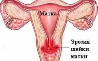 Может ли эрозия пройти сама