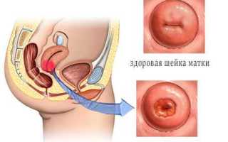 Диагностика эрозии шейки матки