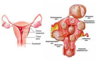 Причины возникновения миомы матки