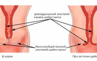 Эрозия шейки матки: как зачать и выносить ребёнка