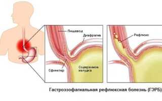 Отрыжка у беременных: как избавиться от неприятного симптома