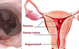 Как лечить гиперплазию эндометрия матки