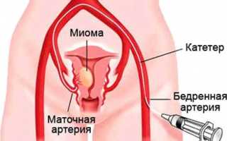 Как быстро растет миома матки