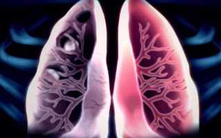 Факторы увеличивающие риск повторного заболевания туберкулезом