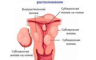 Симптомы миомы матки на ранних стадиях
