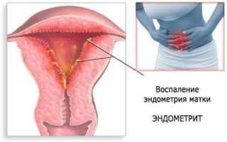 Что такое хронический эндометрит