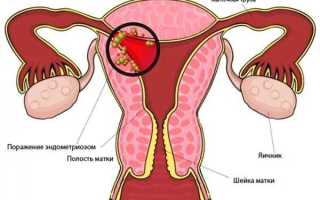 Способы удаления эндометриоза