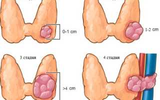 Рак щитовидной железы, прогнозы