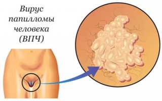 Лечение впч 16 и 18 типов у женщин