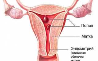 Что такое железистый полип эндометрия