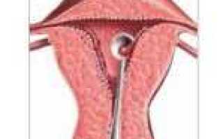 Лечение эндометрия тела матки
