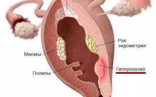 Как при гиперплазии изменяется толщина эндометрия