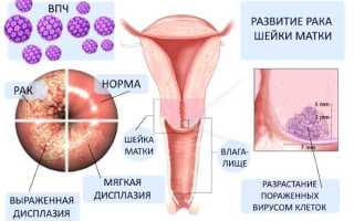 Анализы на определение рака шейки матки