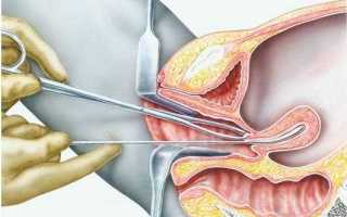 Зондирование матки