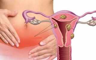 Лечение миомы матки гормональными препаратами