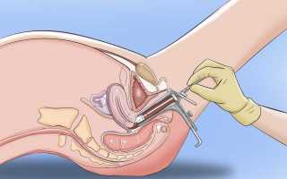 Лечение паракератоза шейки матки