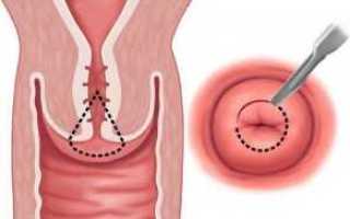 Ампутация шейки матки по штурмдорфу