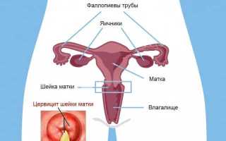 Как лечить воспаление шейки матки свечами