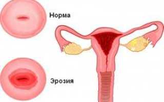 Как лечат эрозию шейки матки у нерожавших