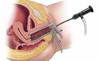 Как проводится гистероскопия эндометрия