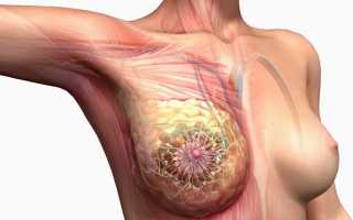 Инфильтративный рак молочной железы