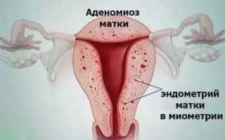Какими препаратами лечится аденомиоз матки