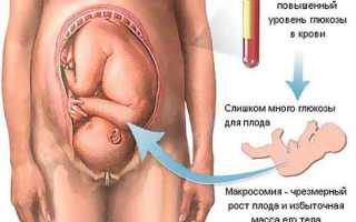 Глюкоза при беременности