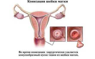 Как лечится дисплазия шейки матки