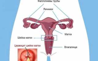 Цервицит шейки матки